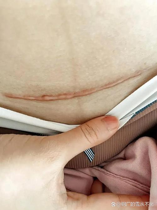 怀孕期间小腹韧带拉伤是怎么回事?该怎么缓解和预防?-第3张图片-郑州医学网 怀孕期间小腹韧带拉伤是怎么回事?该怎么缓解和预防?-第3张图片-郑州医学网