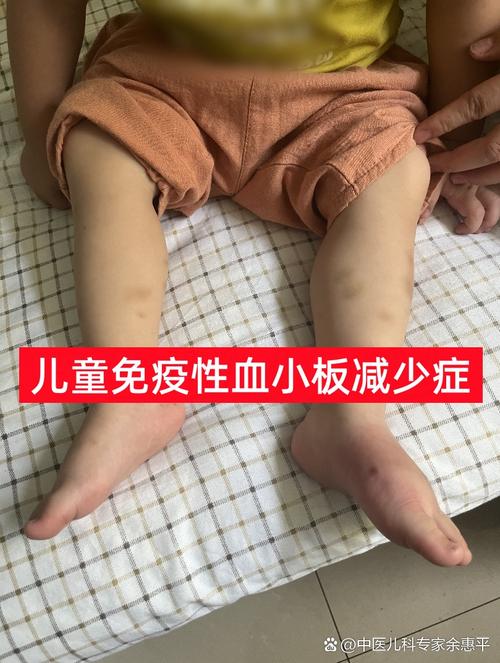 儿童低血压有哪些常见症状？不同年龄段表现有何差异？-第1张图片-郑州医学网