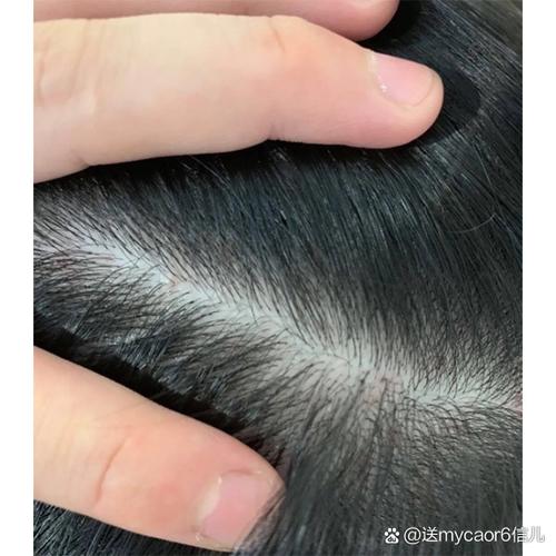 儿童头发油多是饮食不当还是激素变化？如何判断具体原因并有效改善？-第1张图片-郑州医学网