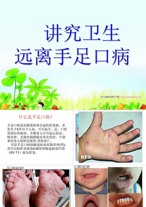 儿童手足口病高发季，家长该如何科学预防才能有效保护孩子？-第3张图片-郑州医学网