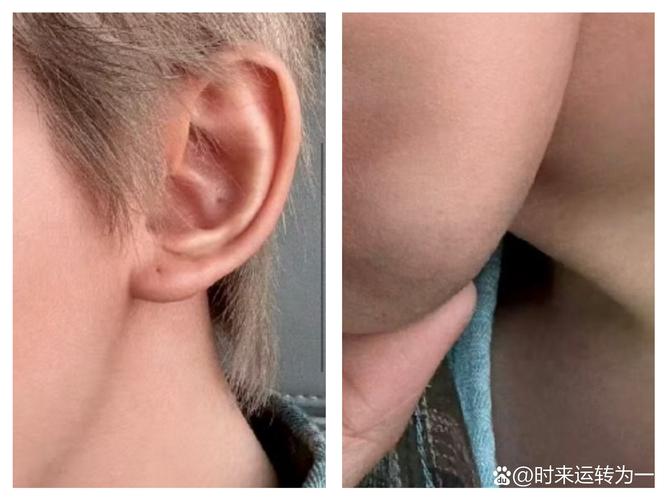 儿童颈部静脉窦是否存在？正常情况下需要关注吗？-第3张图片-郑州医学网