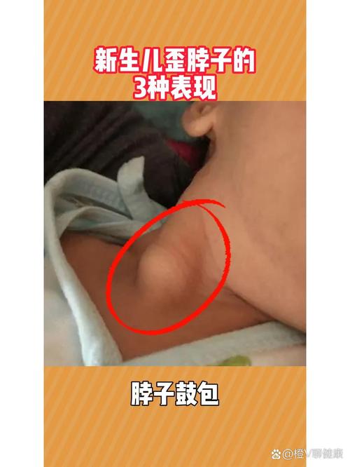 儿童颈部静脉窦是否存在？正常情况下需要关注吗？-第2张图片-郑州医学网