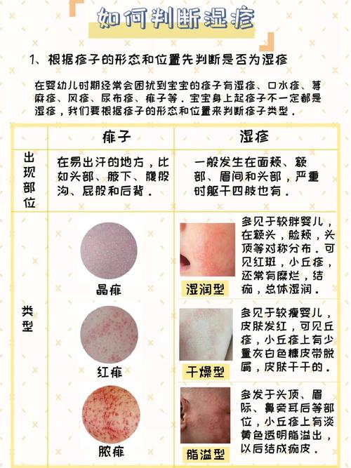 新生儿为何频发湿疹？皮肤屏障脆弱与过敏因素如何交织影响？-第2张图片-郑州医学网