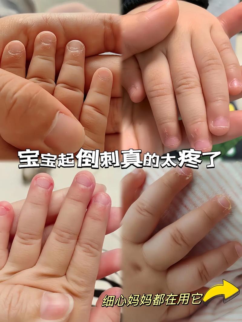 20天新生儿手上长倒刺是缺营养还是护理不当？新手爸妈该如何正确处理？-第1张图片-郑州医学网
