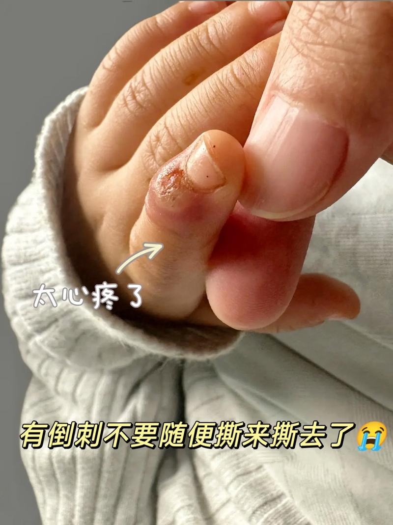 20天新生儿手上长倒刺是缺营养还是护理不当？新手爸妈该如何正确处理？-第3张图片-郑州医学网