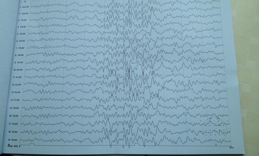 新生儿做脑电图到底会不会影响大脑发育？安全吗？家长最该了解的这些事！-第2张图片-郑州医学网