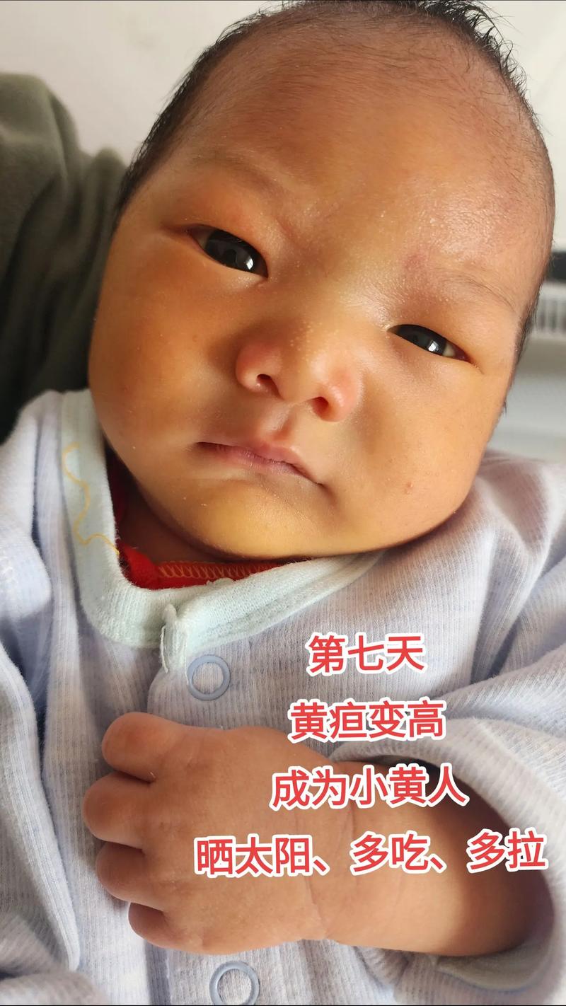 新生儿黄疸12天还没退,是正常现象还是需要就医检查?-第2张图片-郑州医学网 新生儿黄疸12天还没退,是正常现象还是需要就医检查?-第2张图片-郑州医学网