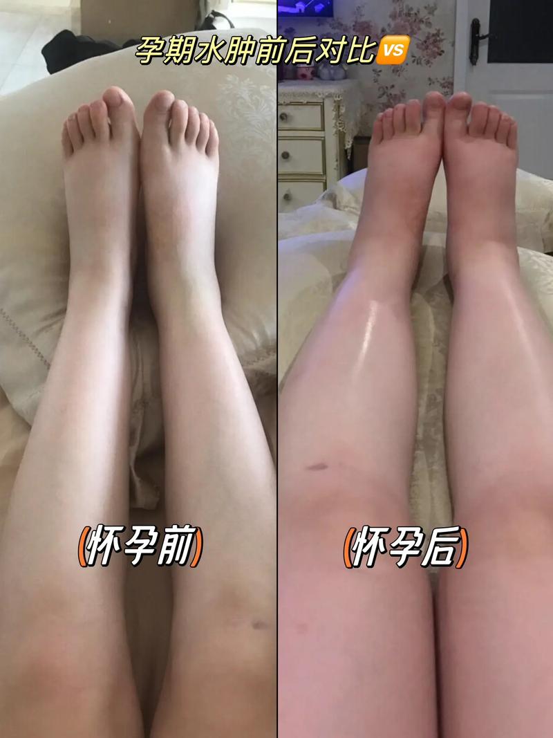 孕期38周水肿严重怎么办？这些缓解方法安全有效吗？-第2张图片-郑州医学网