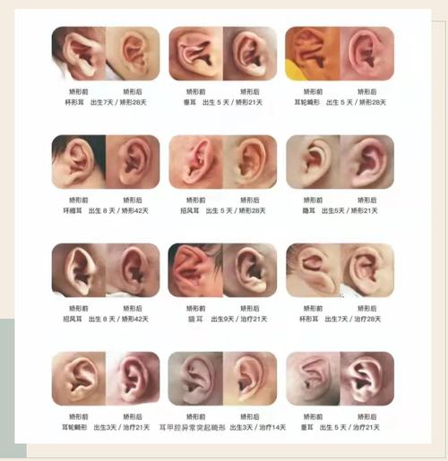 新生儿耳朵轮廓畸形图片能看出哪些具体问题?需要早期干预吗?-第1张图片-郑州医学网 新生儿耳朵轮廓畸形图片能看出哪些具体问题?需要早期干预吗?-第1张图片-郑州医学网