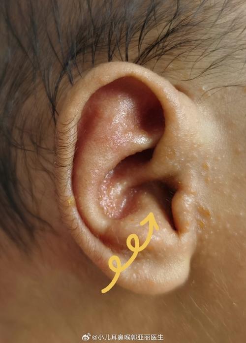 新生儿耳朵轮廓畸形图片能看出哪些具体问题？需要早期干预吗？-第2张图片-郑州医学网