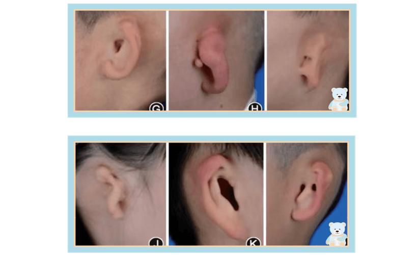 新生儿耳朵轮廓畸形图片能看出哪些具体问题？需要早期干预吗？-第3张图片-郑州医学网