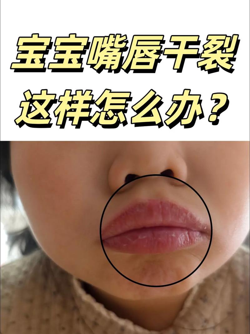 儿童嘴皮干裂是缺水还是生病了？家长该怎么正确处理和预防？-第1张图片-郑州医学网