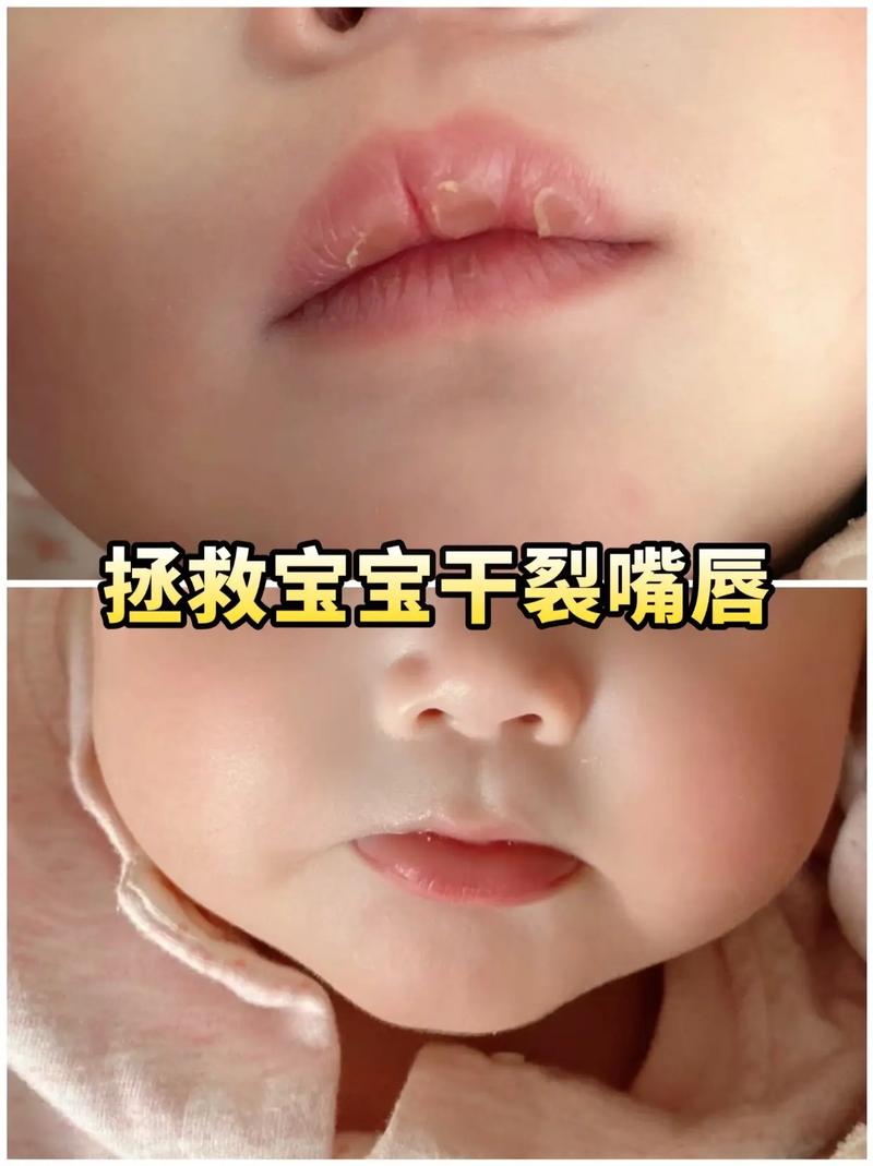 儿童嘴皮干裂是缺水还是生病了？家长该怎么正确处理和预防？-第2张图片-郑州医学网