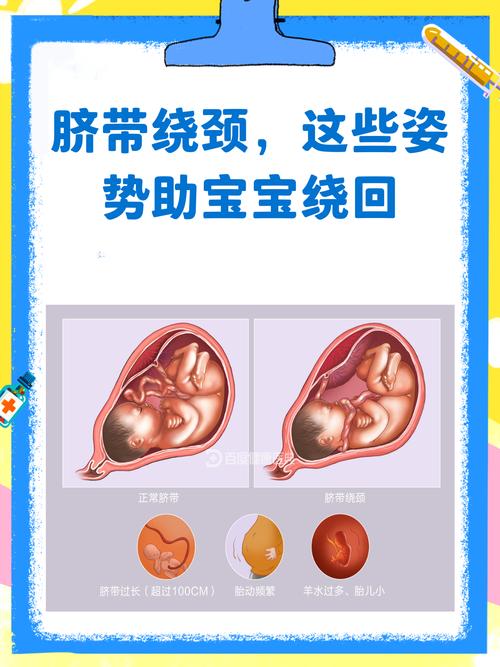 孕期如何有效预防脐带绕颈？这些科学方法真的管用吗？-第2张图片-郑州医学网