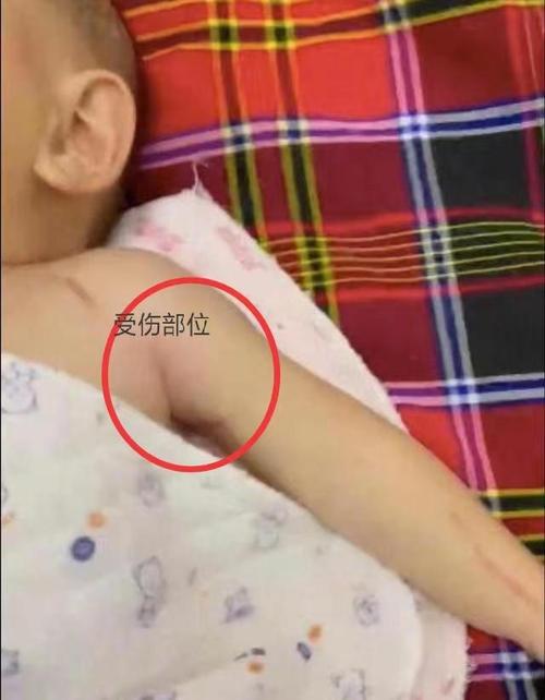 新生儿臂丛神经损伤有哪些典型症状?如何早期识别与干预?-第2张图片-郑州医学网 新生儿臂丛神经损伤有哪些典型症状?如何早期识别与干预?-第2张图片-郑州医学网