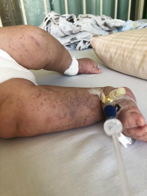 儿童急性血小板减少性紫癜的病因、症状及治疗要点有哪些？-第3张图片-郑州医学网