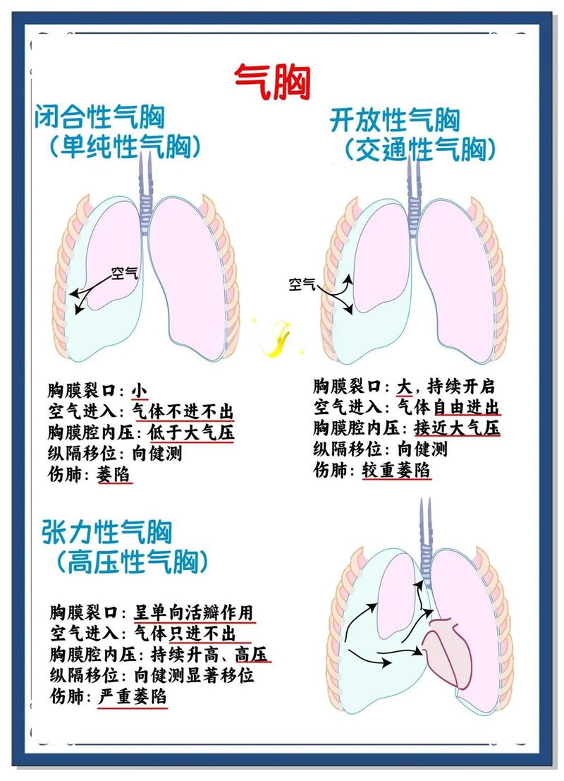 新生儿气胸的诱因有哪些？产伤、窒息还是其他潜在因素在作祟？-第1张图片-郑州医学网