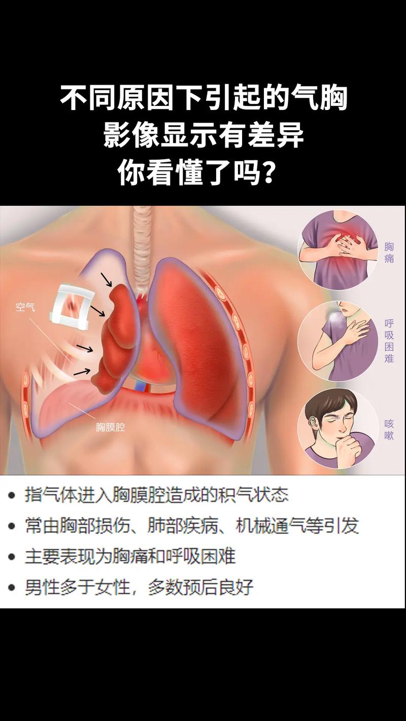 新生儿气胸的诱因有哪些？产伤、窒息还是其他潜在因素在作祟？-第2张图片-郑州医学网