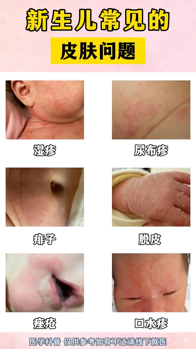 新生儿湿疹反复发作会影响宝宝发育吗？家长该如何科学应对？-第2张图片-郑州医学网