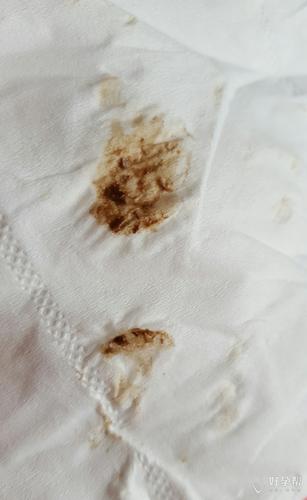 孕期宫腔积液排出颜色异常,会对胎儿造成哪些影响?-第2张图片-郑州医学网 孕期宫腔积液排出颜色异常,会对胎儿造成哪些影响?-第2张图片-郑州医学网