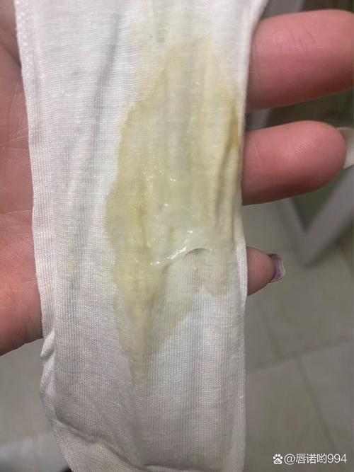 孕期宫腔积液排出颜色异常,会对胎儿造成哪些影响?-第1张图片-郑州医学网 孕期宫腔积液排出颜色异常,会对胎儿造成哪些影响?-第1张图片-郑州医学网