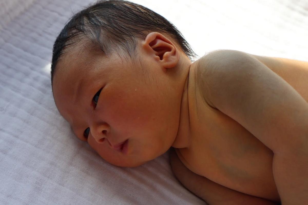 新生儿15天黄疸还没退,是正常现象还是需要干预?-第2张图片-郑州医学网 新生儿15天黄疸还没退,是正常现象还是需要干预?-第2张图片-郑州医学网