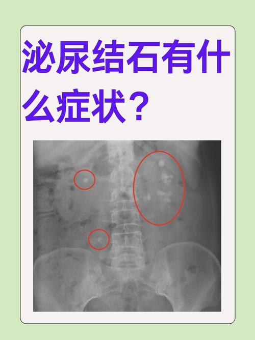 儿童尿结石早期症状有哪些?家长该如何及时发现与应对?-第1张图片-郑州医学网 儿童尿结石早期症状有哪些?家长该如何及时发现与应对?-第1张图片-郑州医学网