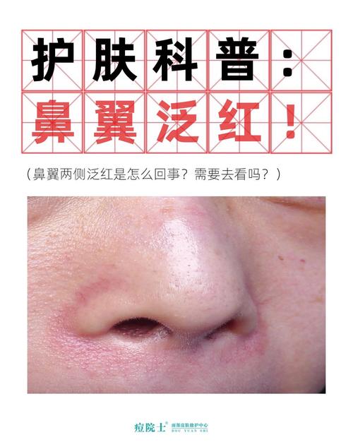 孕期鼻头变红是激素变化还是皮肤敏感在作祟？-第2张图片-郑州医学网