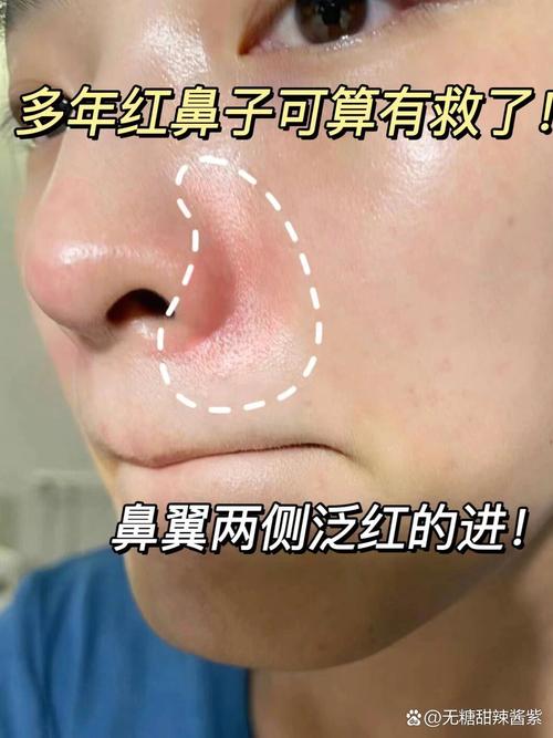 孕期鼻头变红是激素变化还是皮肤敏感在作祟？-第3张图片-郑州医学网