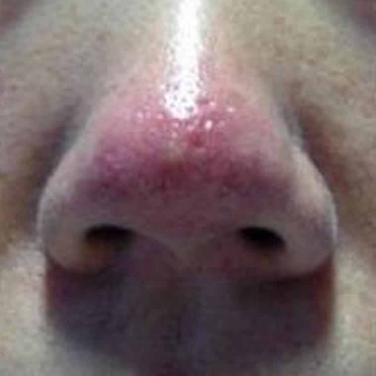 孕期鼻头变红是激素变化还是皮肤敏感在作祟？-第1张图片-郑州医学网