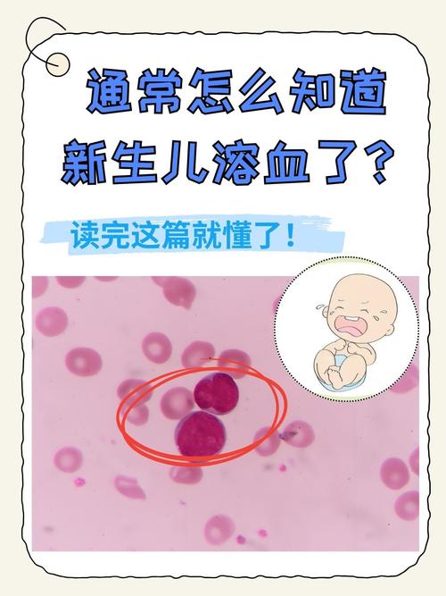 OB溶血究竟会对新生儿造成哪些不可逆的伤害？-第2张图片-郑州医学网
