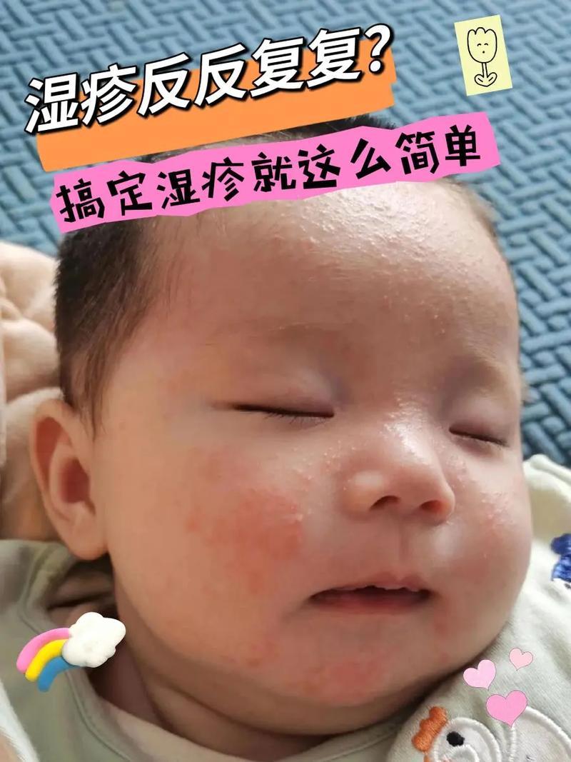 新生儿湿疹症状图片有哪些典型表现？如何辨别不同严重程度的湿疹？-第2张图片-郑州医学网