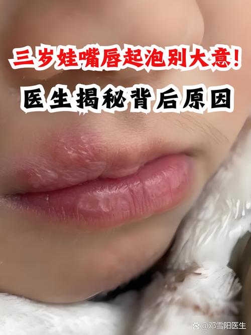 儿童口唇疱疹图片大全,不同阶段症状长啥样?家长如何判断和护理?-第1张图片-郑州医学网 儿童口唇疱疹图片大全,不同阶段症状长啥样?家长如何判断和护理?-第1张图片-郑州医学网