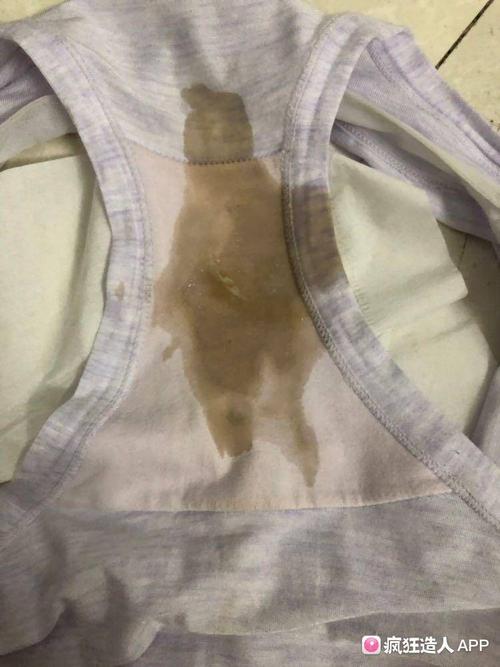 孕期盆腔积液会自行排出吗？对胎儿有影响吗？需要治疗吗？-第3张图片-郑州医学网