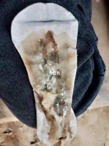 孕期盆腔积液会自行排出吗？对胎儿有影响吗？需要治疗吗？-第1张图片-郑州医学网