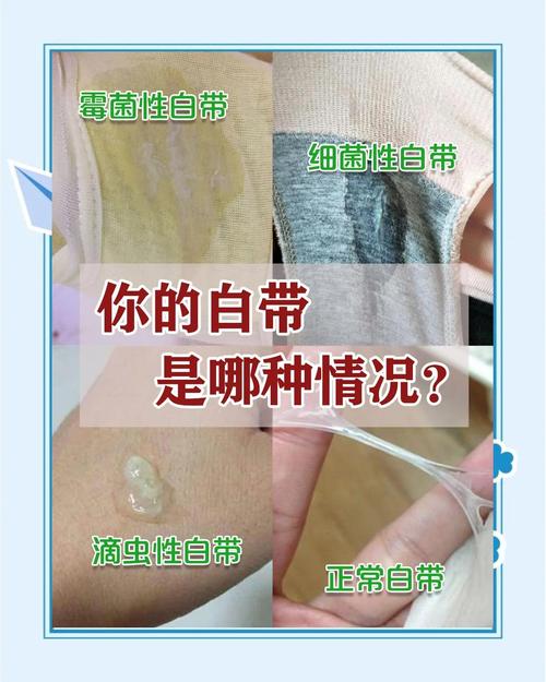 孕期白带变化正常吗？不同阶段会有哪些异常信号需警惕？-第1张图片-郑州医学网