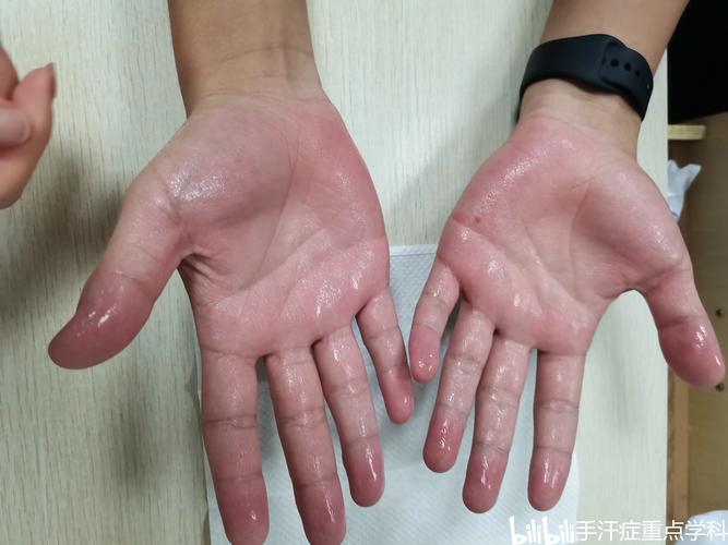儿童手脚出汗是病吗？背后隐藏哪些健康问题？-第3张图片-郑州医学网