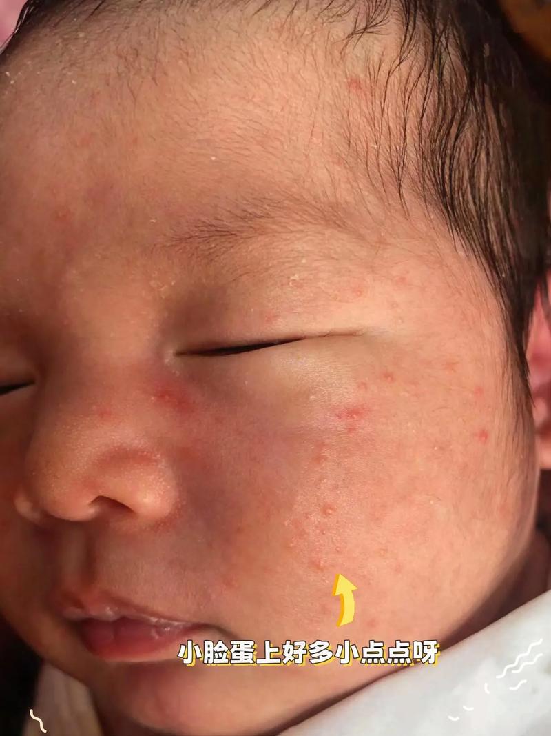 新生儿脸上起湿疹怎么办？日常护理与用药需注意哪些事项？-第2张图片-郑州医学网