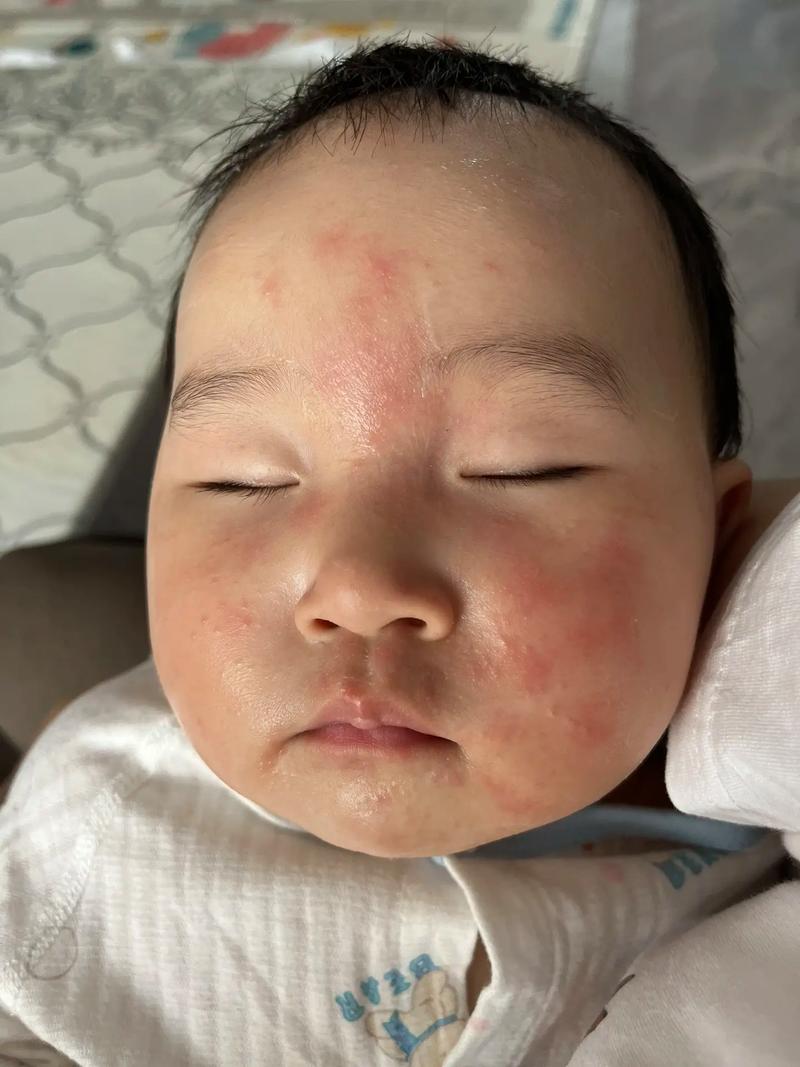 新生儿脸上起湿疹怎么办？日常护理与用药需注意哪些事项？-第1张图片-郑州医学网
