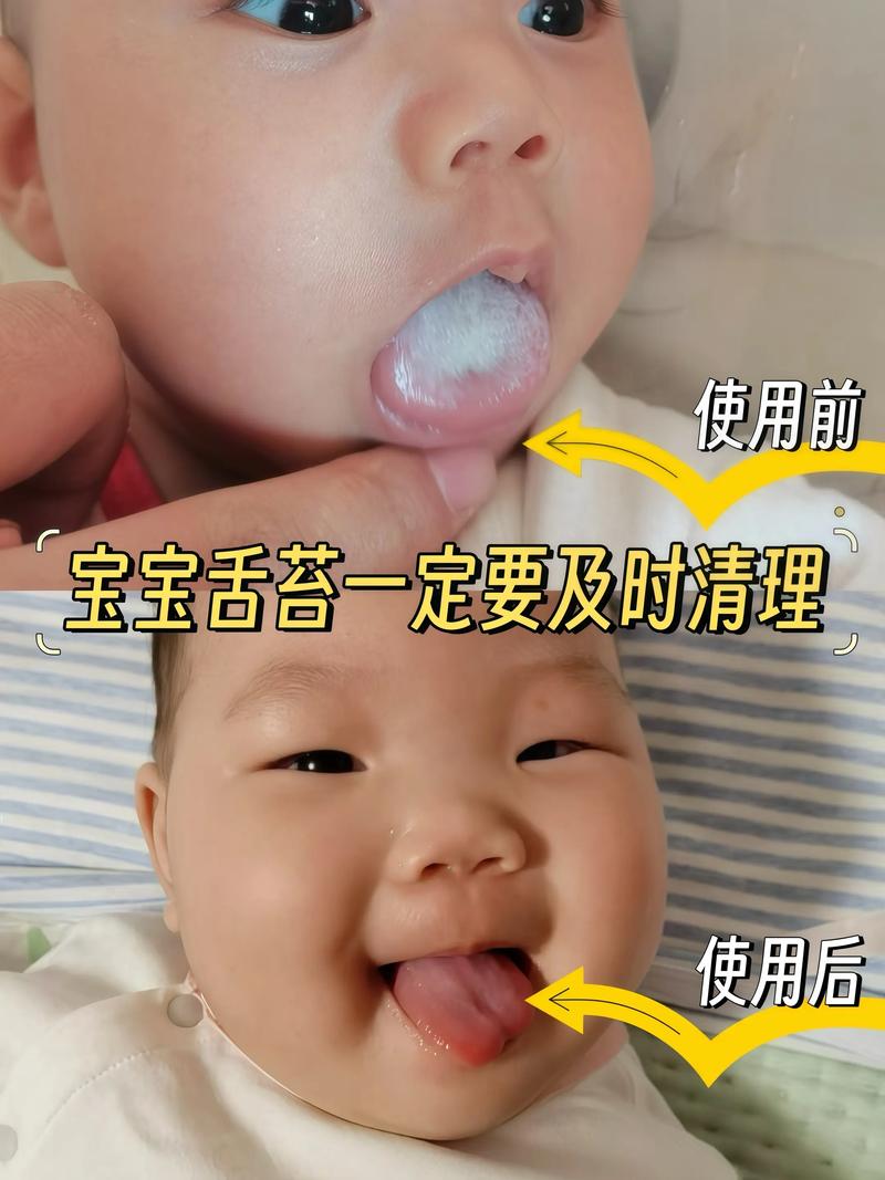 新生儿舌苔白是正常现象还是健康预警？需关注哪些潜在原因？-第3张图片-郑州医学网