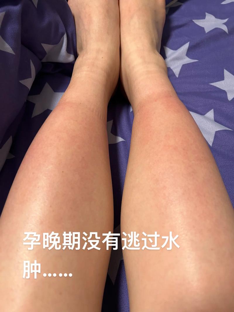 孕期28周出现水肿是正常的生理现象吗？需要担心吗？-第1张图片-郑州医学网