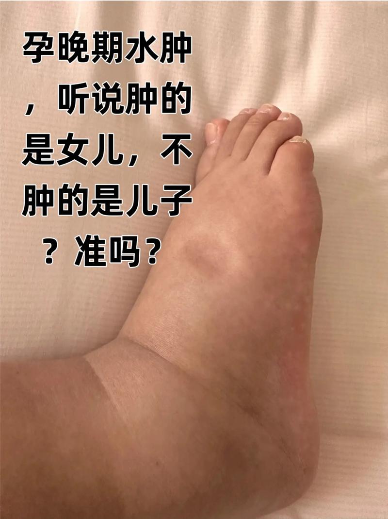 孕期28周出现水肿是正常的生理现象吗？需要担心吗？-第3张图片-郑州医学网