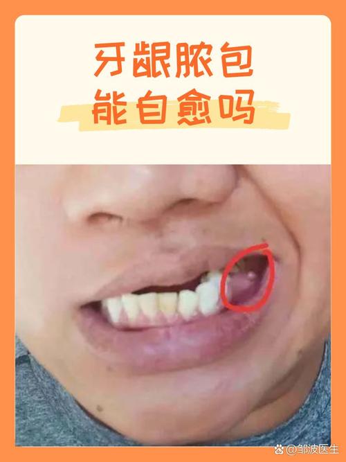 儿童牙龈长脓包是上火还是牙齿问题？如何正确处理与预防？-第2张图片-郑州医学网