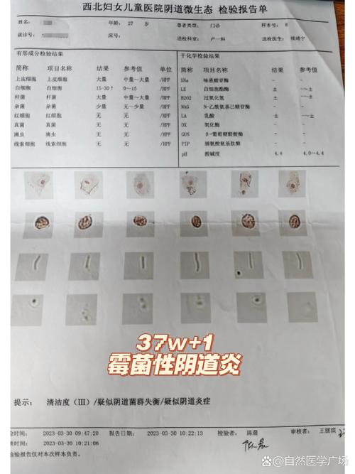 孕期霉菌感染后能否自愈？会对胎儿造成影响吗？-第2张图片-郑州医学网