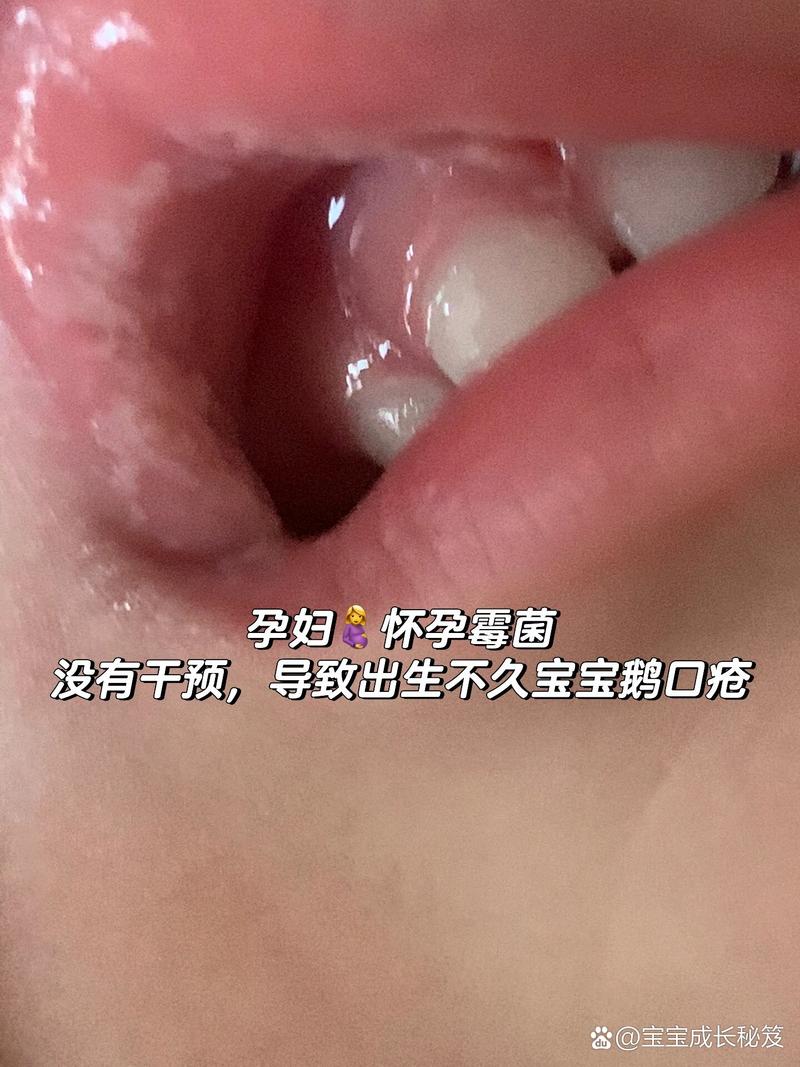 孕期霉菌感染后能否自愈？会对胎儿造成影响吗？-第3张图片-郑州医学网