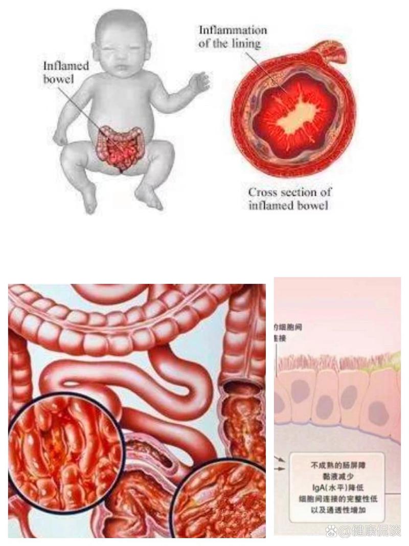 新生儿肠炎究竟是什么原因引起的？又该如何科学预防与护理呢？-第2张图片-郑州医学网