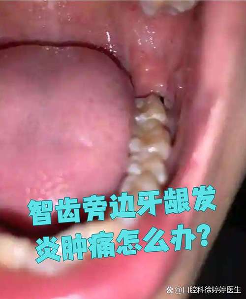 孕期智齿发炎到底多久能好？对胎儿有影响吗？怎么处理才安全？-第2张图片-郑州医学网