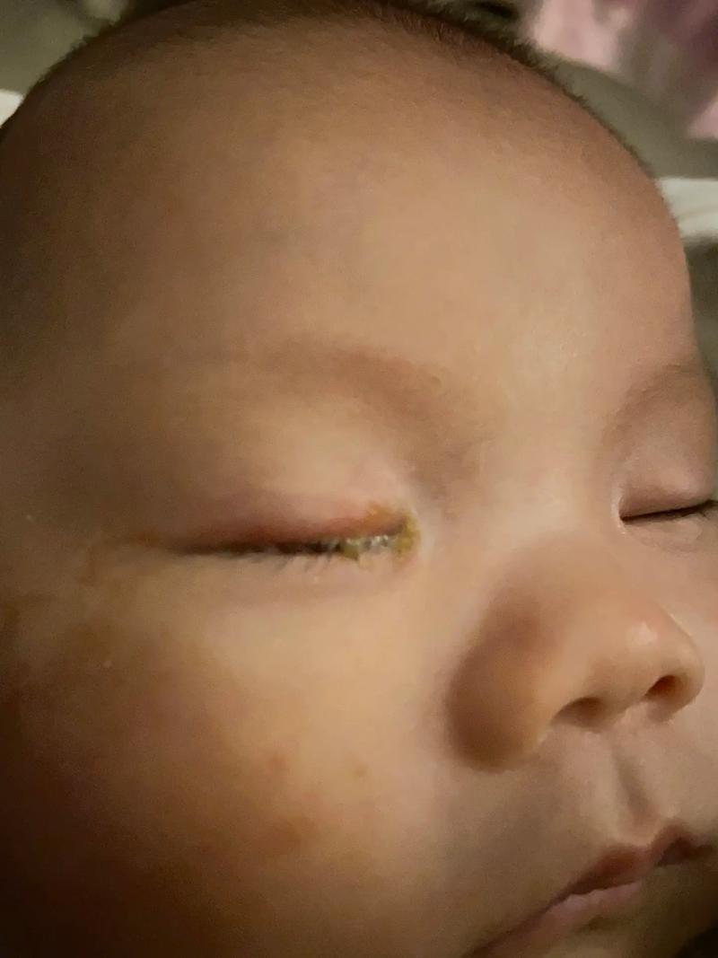 新生儿频繁出现眼屎是上火还是疾病信号？如何判断是否需要就医？-第3张图片-郑州医学网