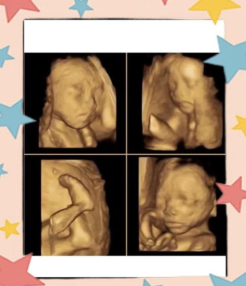 孕期彩超究竟能检查出哪些关键问题？胎儿健康与发育情况全解析！-第2张图片-郑州医学网