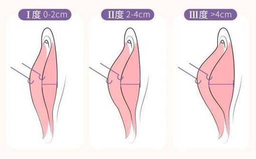 孕期阴道内侧长小颗粒是什么原因？需要担心吗？-第2张图片-郑州医学网